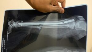 Gam Yang Membolehkan Tulang Patah Disambung Tanpa Skru Atau Plat Besi Dibangunkan Saintis