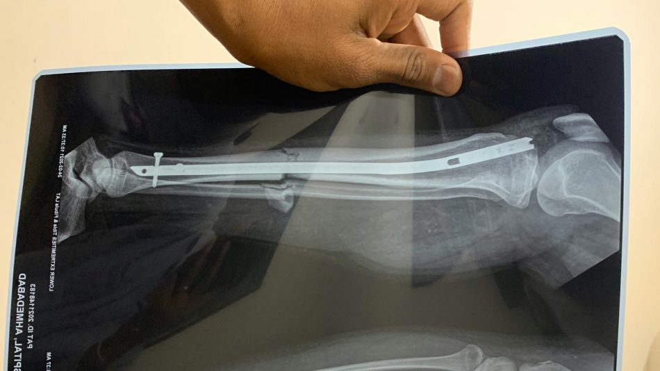 Gam Yang Membolehkan Tulang Patah Disambung Tanpa Skru Atau Plat Besi Dibangunkan Saintis