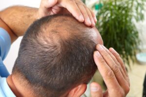 Stevia boleh atasi masalah botak