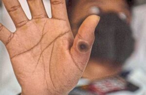 Govt confirms new mpox cluster involving four relatives