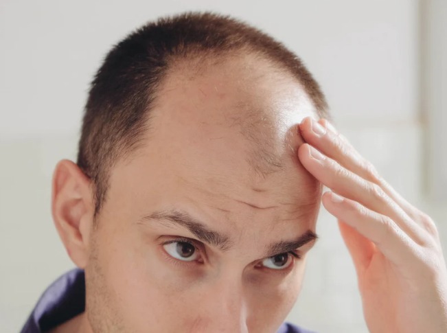 Kenapa lelaki lebih mudah jadi botak?