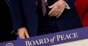 Trump: Bruising on hand caused by hitting table