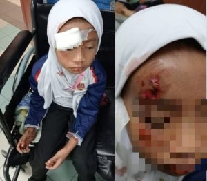 Dahi berlubang, murid darjah dua cedera langgar lari