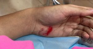 Form Five student injured in fall while being chased by stray dogs