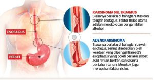 Makanan sering ‘naik semula’ di esofagus? Itu mungkin kanser!