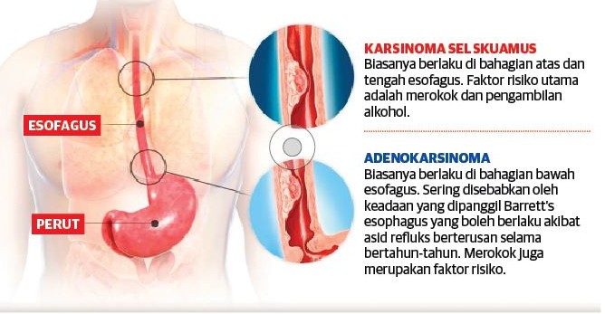 Makanan sering ‘naik semula’ di esofagus? Itu mungkin kanser!